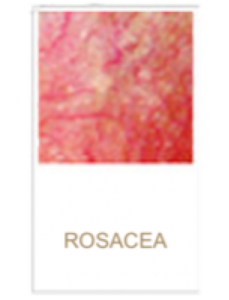 Rosacea Skin